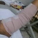 My arms were done too :-)