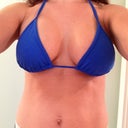 6wk post op