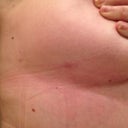 Lipo incision under right breast - Post Op Day 28