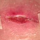 Part of incision that's still not drying out properly.  I have three of these in total along the incision.   There are two that look like this - about a centimeter in circumference, and then I have an area along the incision that is a very thin line that is about 3 centimeters long.  They are improving, but they're taking their sweet time!