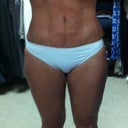 This was taken on Jan 25. 3 days after my last procedure.