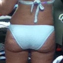 This was taken on Jan 25. 3 days after my last procedure.