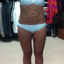 This was taken on April 20. Almost 3 months post-op.