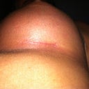 Left incision