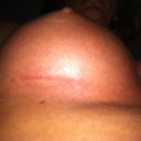 Right incision