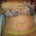 post op day 5