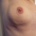 25 Days - Right Incision