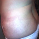 3 day post op