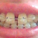 Damon Clear braces on, top and bottom teeth.