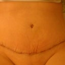 2 weeks and 5 days post surgery