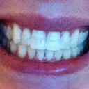 Bite (no aligners) 3/4 way through