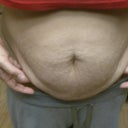 I dieted before my surgery.  Down 10lbs, and the flabby 'wings appeared.  A few years back I lost 20lbs and the flab was worse!