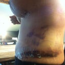 day 8 po.  i bruised really bad on my left side