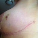 post op day 23, left breast. That bruise appeared about a week ago and is slowly fading. My incision is healing and the lateral point, under my arm, is softening.