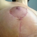 post op day 23. This is the open spot under my left areola, aka scary spot number 2. It's healing, but I still wonder if there's a dissolvable suture in there. We'll see what the PS thinks on Wednesday.