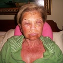 Day 1 Post Op, home from the procedure. YIKES