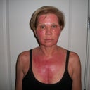 Day 7 and this is the first day that I can kinda agree with the idea of "feels like a sunburn"  This is a very intense healing process.