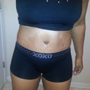 PO Day 7 .FIRST PICS IN BOY SHORTS. SWOLLEN LIKE CRAZY