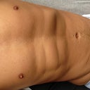 11 weeks post surgery. The swelling is going down and it is starting to look better and better. It's making me even more determined to eat well and make sure not to put weight back on.