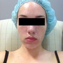 10 mins before pixel, numbing cream applied.