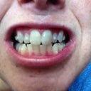 My teeth with buttons in place and invisaligns out. This is not how I smile, lol, just trying to show all the buttons.