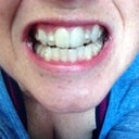 My teeth with buttons and invisalign in.