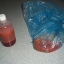 what they cut off and drained out. ( about 2.5 kg of fat and skin)