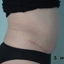 I can barely breath from swelling from PMS.  I am 1 month here