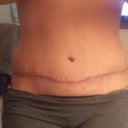 25 days post op... First thing in the morning. Results not typical in the evening;)