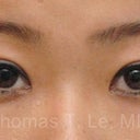 Young Asian Female Underwent Asian Upper Blepharoplasty To Create Double Eyelid Crease