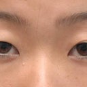 Young Asian Female Underwent Asian Upper Blepharoplasty To Create Double Eyelid Crease
