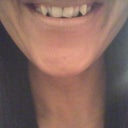 Before Dental Bonding (two "fang" like teeth).