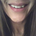 After Dental Bonding ("fang" like teeth were "softened").