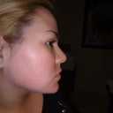 4 weeks later! still under treatment..
