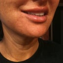 This is my "good" side - the only smile I have left. Taken 10 days after injections. on 9/30/11