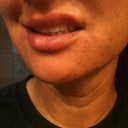 This is the only smile I have on the other side.  Quite the sneer. Taken 10 days after injections.