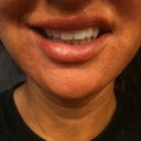 This is my full smile.  How distorted. Taken 10 days after injections.