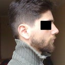 10 days after op, quite upturned and feminine nose.