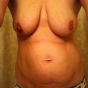 Not a pretty sight! :o/  Cant wait for that inverted nipple from pregnancy to be fixed too!