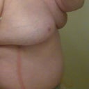 Side following surgery - you can see the drainage tubes. They now look like a typical 57 year old woman's breast. I'm pleased.