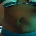 1 month post op