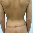 TWO-WEEKS POST-OP: Here's a view of me from the back, after undergoing a great lower body lift from Dr. Khuthaila, one of NYC's most talented top surgeons.