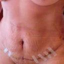 4 days post op