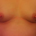 Before thank goodness I was having the mole removed