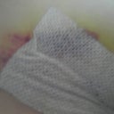 Closer pic of bruise.. I think yellow means healing?
