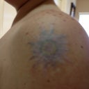 3 weeks after 6th treatment