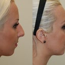 Here is my before and after (5 weeks post surgery)