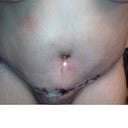 Super swollen!  My belly button is soooo off center.  I hope it corrects itself once the swelling goes away!  =(
