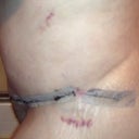 A small part of the tape came off and my scar is minimal!