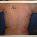 Back 1 day after procedure
